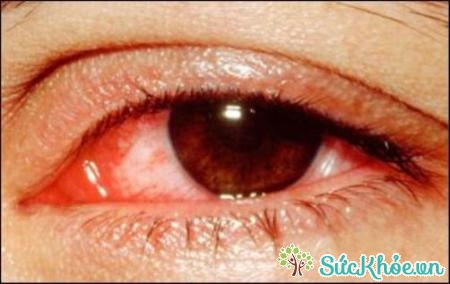 Dị ứng mắt là hiện tượng xảy ra khá thường xuyên