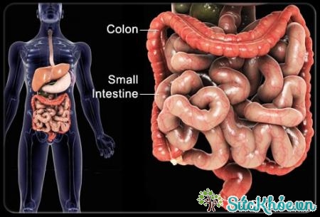 Bệnh Crohn là một thể viêm dạ dày đặc biệt
