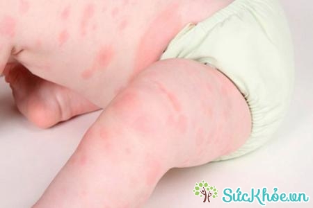 Do da của trẻ em mềm, mỏng nên dễ bị tổn thương bởi tác nhân bên ngoài