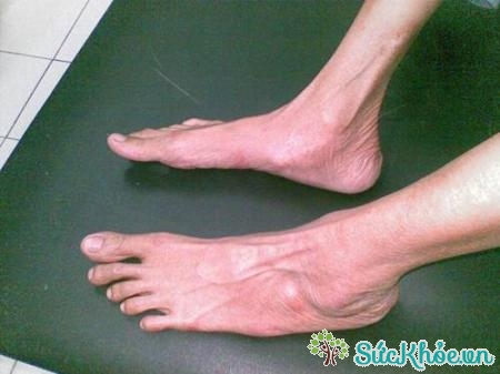 Xương bàn chân người mắc hội chứng Marfan thường dài