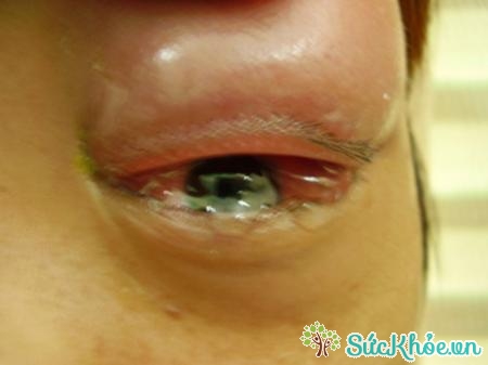 Dị ứng thuốc sưng mắt là bệnh lý mà bạn tuyệt đối không được xem thường