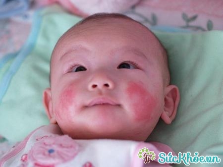 Ở trẻ sơ sinh bệnh chàm Eczema thường khởi phát trên mặt