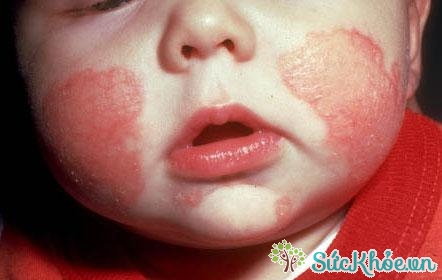 Viêm da Eczema dị ứng là một loại bệnh chàm Eczema phổ biến