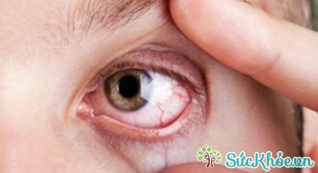 Những người có bệnh về mắt là những người không nên ăn tỏi