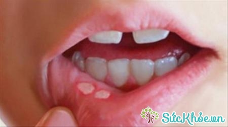 Triệu chứng về viêm niêm mạc miệng, chảy máu chân răng