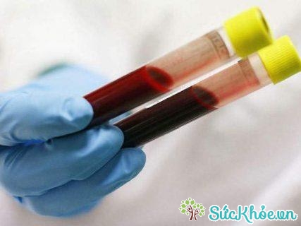 Xét nghiệm máu là xét nghiệm chẩn đoán ung thư đại tràng thường dùng