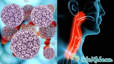 HPV - virus gây ung thư vòm họng là gì?