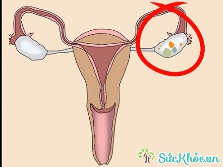 Bệnh có 3 dạng u nang buồng trứng ác tính điển hình