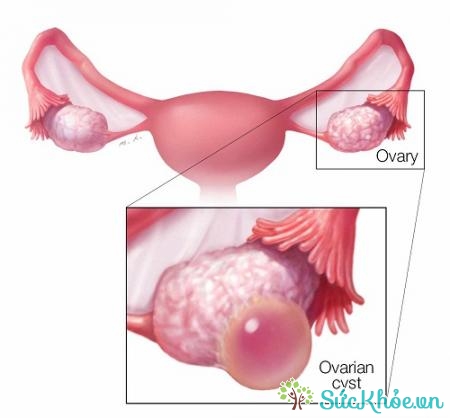 U nang buồng trứng trái nghĩa là khối u nằm trên buồng trứng bên trái