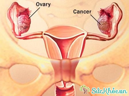 Có bốn giai đoạn phát triển u nang buồng trứng ác tính