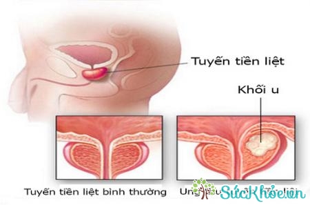 Có nhiều nguyên nhân ung thư tuyến tiền liệt