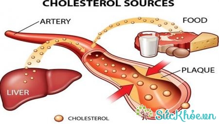 Cholesterol cao là một hậu quả của bệnh béo phì
