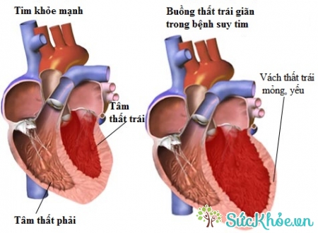 Bệnh van tim do các bệnh về tim mạch gây ra