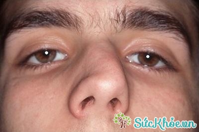 Những nguyên nhân gây vẹo vách ngăn mũi là gì?