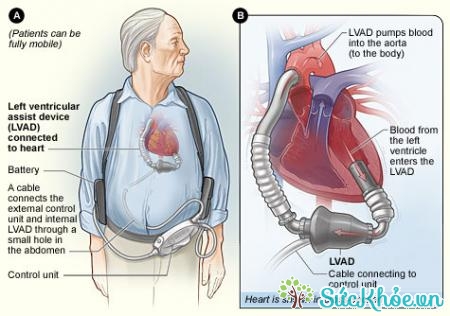 Điều trị các bệnh tim mạch để khắc phục rung nhĩ