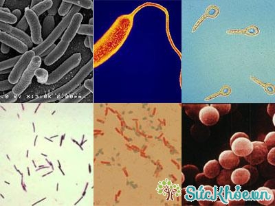Vi trùng Bacterial Vaginosis là một loại nhiễm khuẩn âm đạo