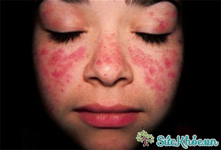 Lupus ban đỏ hệ thống thường gây phát ban ở má