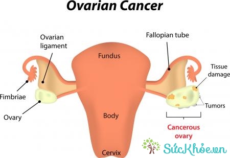 Triệu chứng ung thư buồng trứng giai đoạn đầu là vấn đề về dạ dày