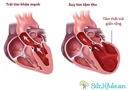 Suy tim tâm trương là biến chứng của suy tim