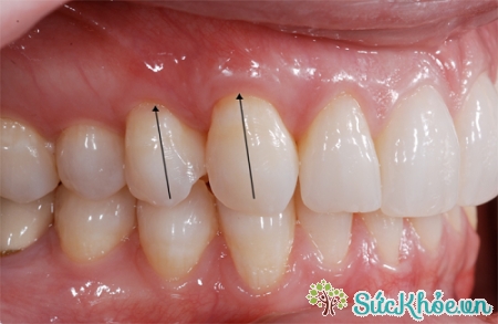 Một trong những biến chứng răng khôn là gây viêm nướu