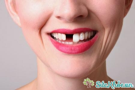 Ảnh hưởng của mọc răng khôn hàm dưới là có thể gây rụng răng