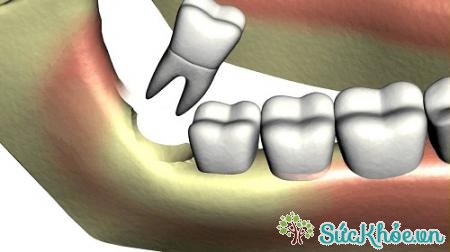 Răng khôn mọc kẹt hầu hết là răng ở hàm dưới