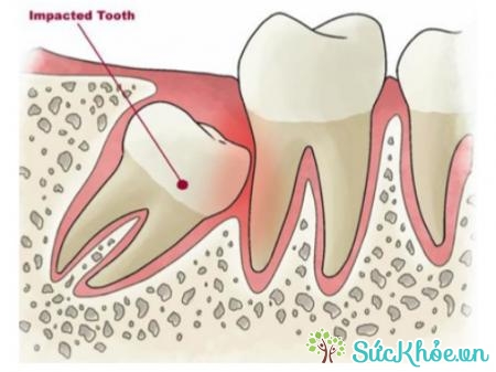 Răng khôn là chiếc răng khối thứ 3 hay còn gọi là răng số 8