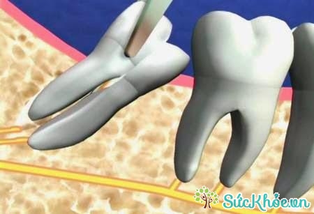 Do không đủ chỗ ở sau răng số 7 nên sẽ gây ra tình trạng răng khôn mọc kẹt