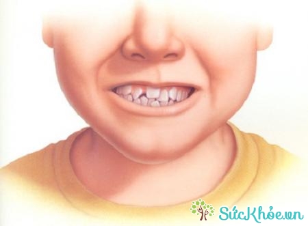Bệnh nghiến răng ở trẻ em có nhiều nguyên nhân gây nên