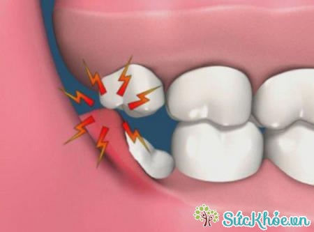 Viêm lợi trùm xảy ra trong thời kỳ mọc răng khôn