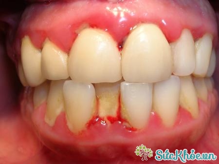 Răng khôn ảnh hưởng đến sức khỏe răng lợi