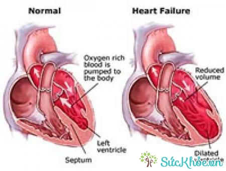 Tràn dịch màng tim ở thai nhi