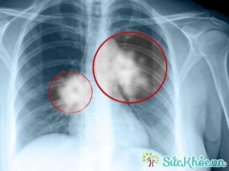 Ung thư xương di căn phổi như thế nào?