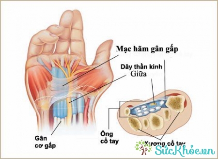 Hội chứng ống cổ tay ảnh hưởng đến dây thần kinh giữa ống cổ tay