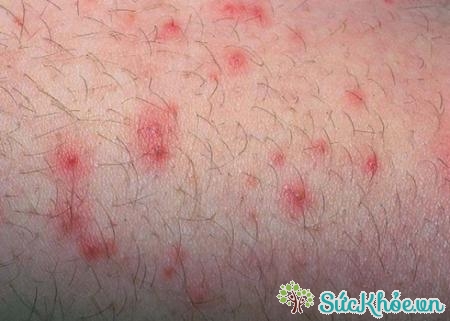 Nhiễm tụ cầu khuẩn gây nổi mẩn trên da như các bệnh ngoài da