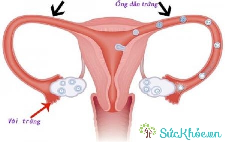 Viêm nhiễm vòi trứng là một nguyên nhân thai ngoài tử cung