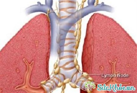 Ho ra máu là biểu hiện của xơ phổi