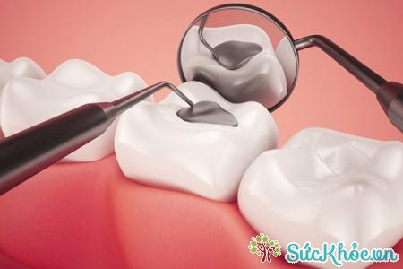 Trám răng là một cách làm răng thẩm mỹ phổ biến