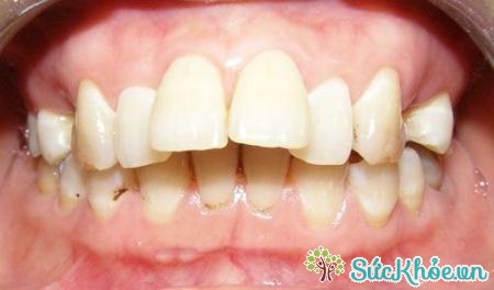 Chụp sứ cho răng áp dụng với các trường hợp răng dài, hô vẩu