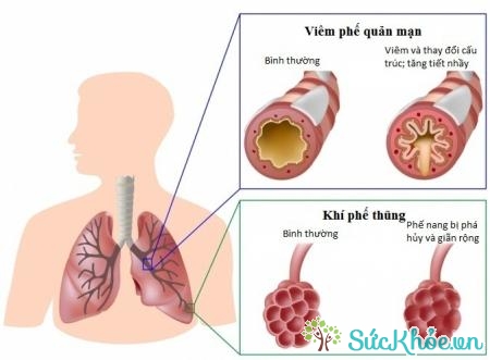Lao phổi, hen phế quản là những bệnh lý gây giãn phế nang
