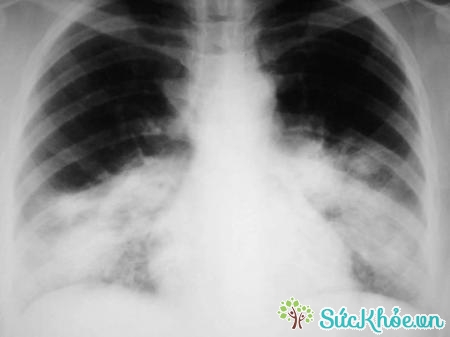 Bệnh nhân tràn khí màng phổi thường ngất xỉu, da xanh