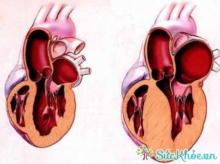 Viêm cơ tim gây ra các cơn đau ngực