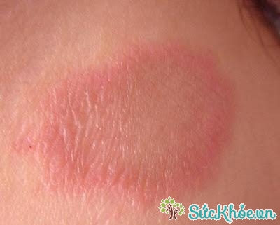 Tổn thương bề mặt da là triệu chứng vảy nến thường gặp
