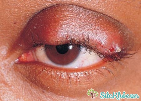Hiện tượng đau mắt đỏ sẽ tấy, sưng vùng mắt