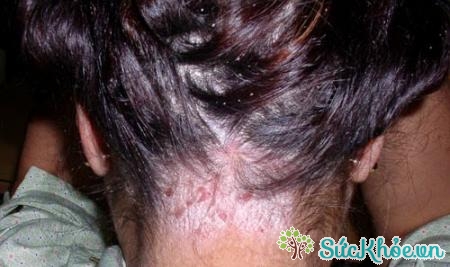 Những triệu chứng vảy nến da đầu