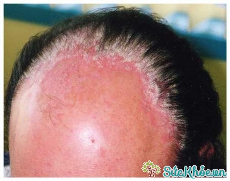 Những nguyên nhân gây vảy nến da đầu thường gặp