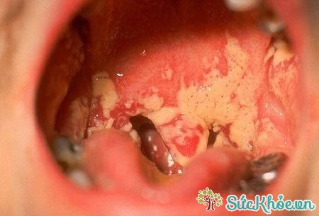 Bệnh lậu ở miệng là một bệnh lý không được xem thường