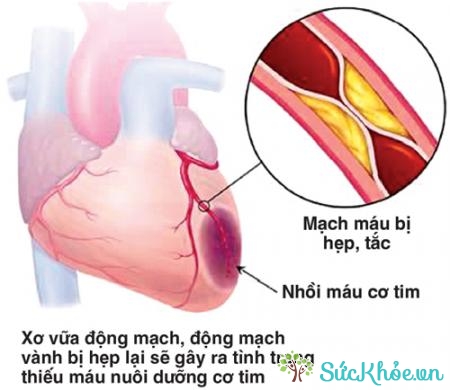 Thiếu máu cục bộ cơ tim còn gọi là bệnh tim thiếu máu cục bộ