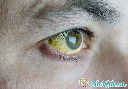 Vành da, vàng mắt là hiện tượng thường gặp ở người mắc bệnh gan