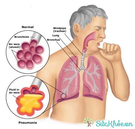 Tắc nghẽn phổi mạn tính nên cai thuốc lá